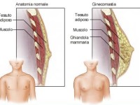 Interventi di Ginecomastia